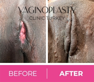 Fgm preop (clitoral and labia minora total excision) / Post op labia minora reconstruction, clitoral reconstruction and labial puff with fat