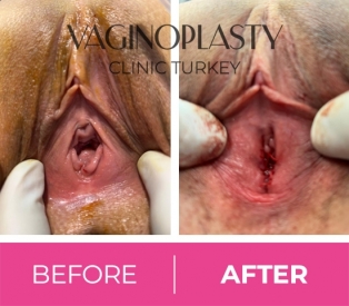 Hymenoplasty before and after