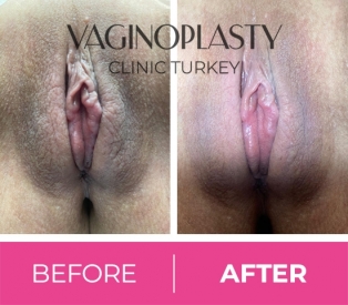 Labial Puff Before / After