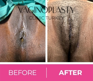 Fgm Reversal Surgery Before & After