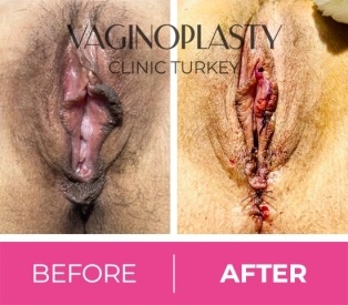 Labiaplasty Before and After