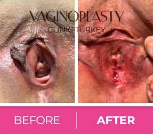 Hymenoplasty before & after