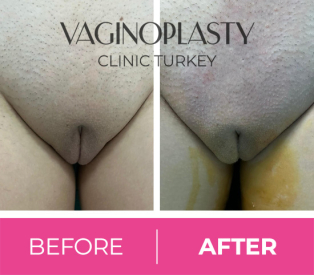 Mons Liposuction Post Op