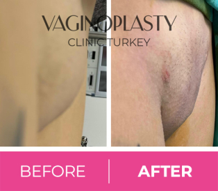 Mons Liposuction Post Op
