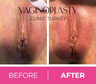 Labial Puff Before and After