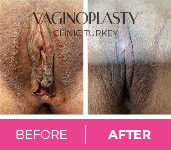 Vaginal Rejuvenation, Tightening, Labiaplasty in Turkey