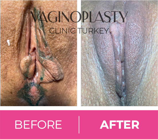 Vaginal Rejuvenation, Tightening, Labiaplasty