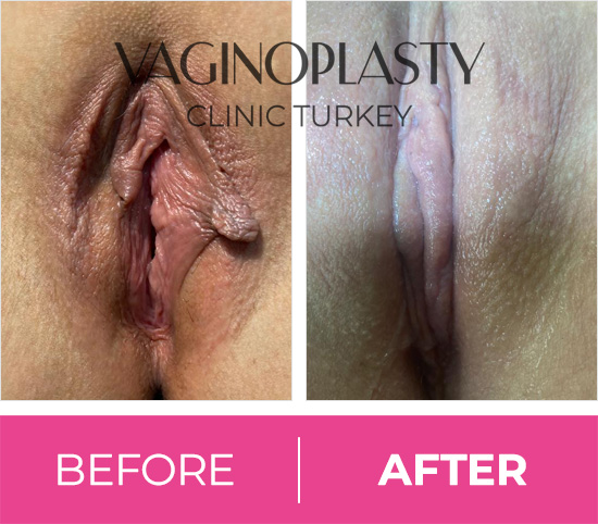 Vaginal Rejuvenation, Tightening, Labiaplasty Cost Turkey