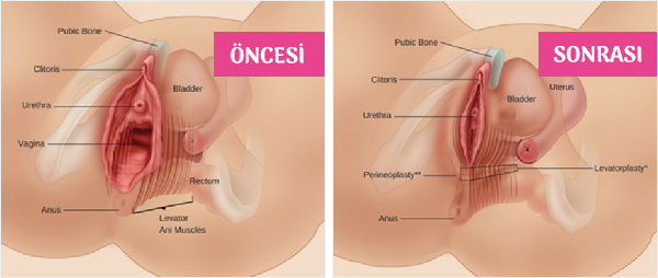 Vajina Daraltma Öncesi / Sonrası